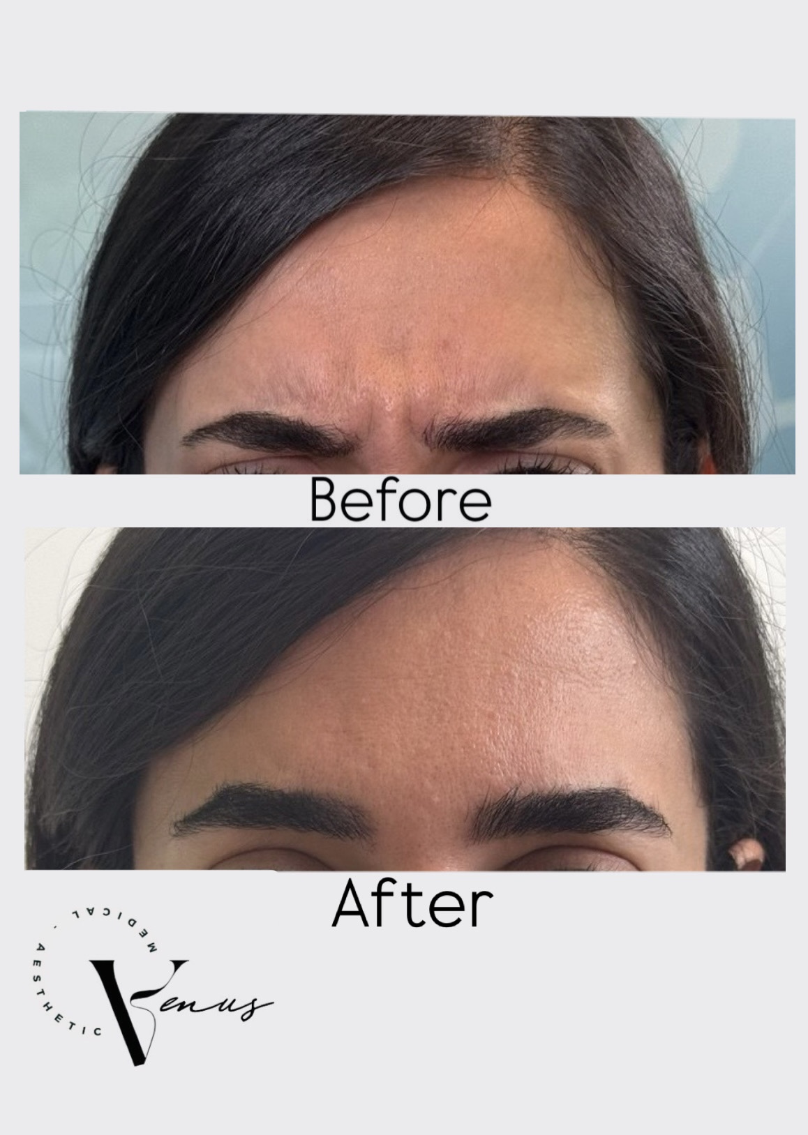 Before and after aesthetic treatment result 1 at Venus Clinic Laval