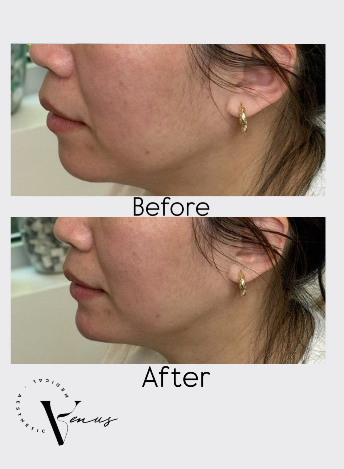 Before and after aesthetic treatment result 8 at Venus Clinic Laval