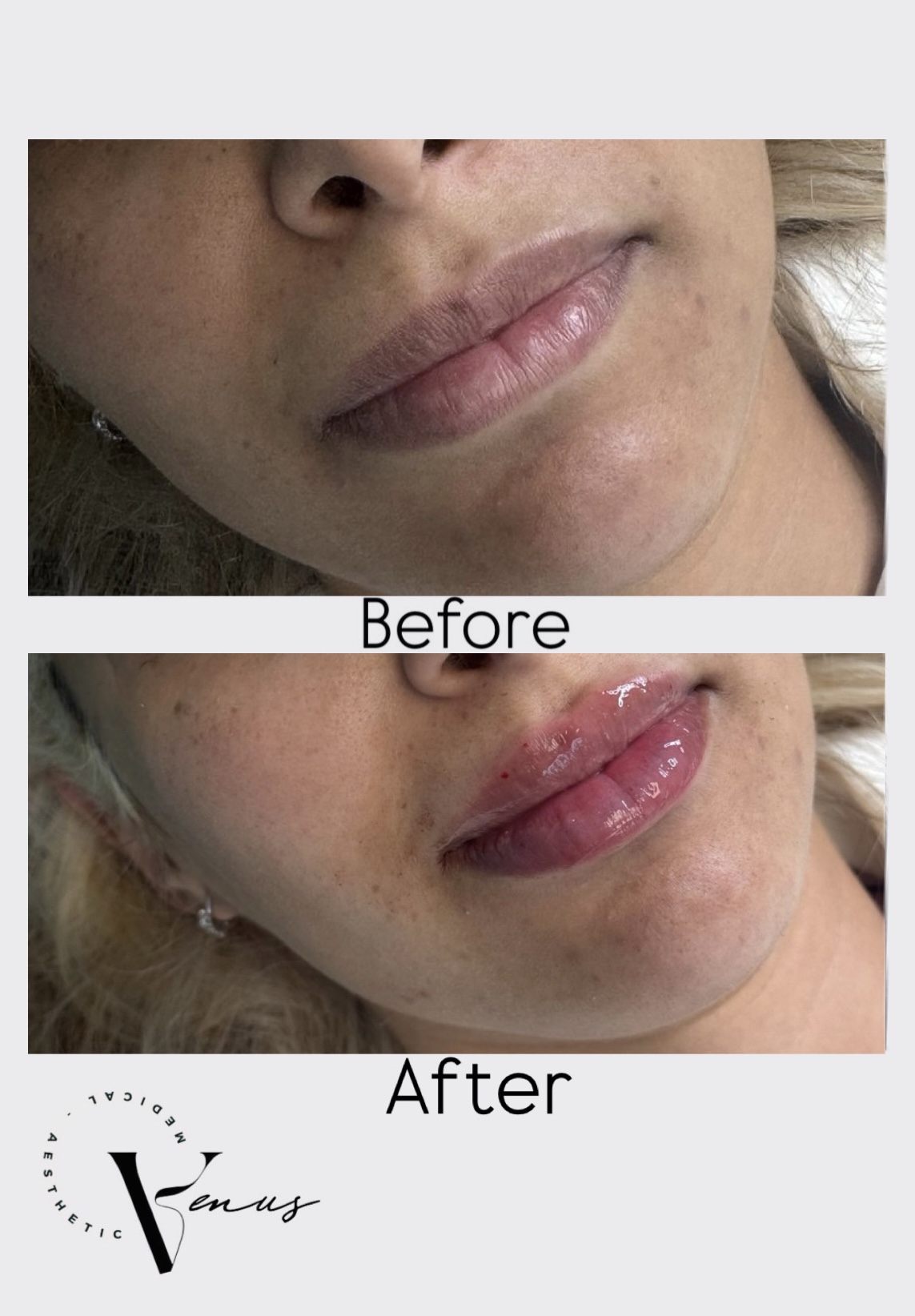 Before and after aesthetic treatment result 9 at Venus Clinic Laval
