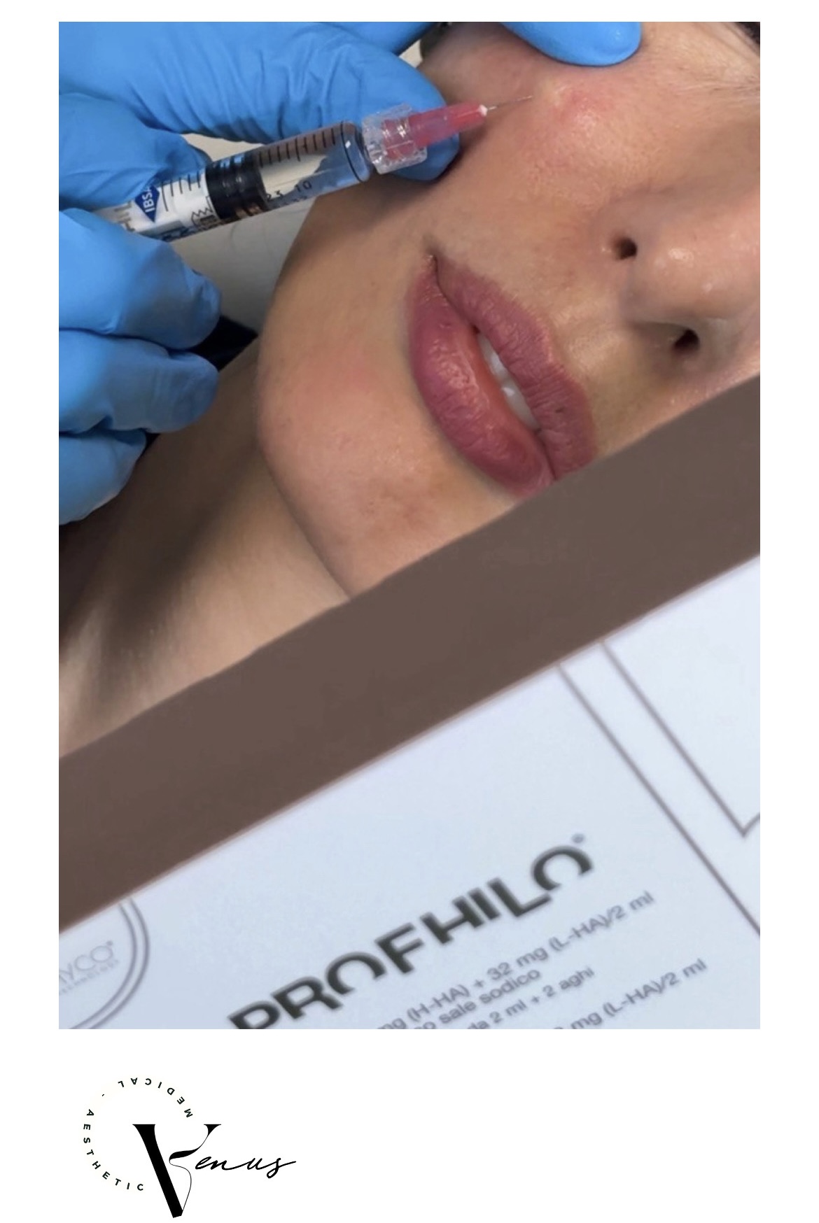 Before and after aesthetic treatment result 10 at Venus Clinic Laval