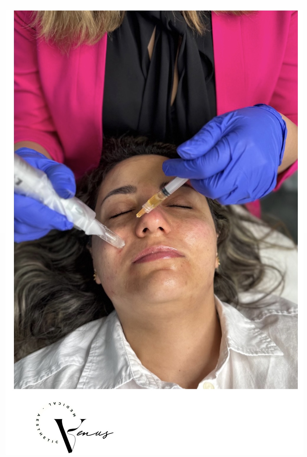 Before and after aesthetic treatment result 11 at Venus Clinic Laval