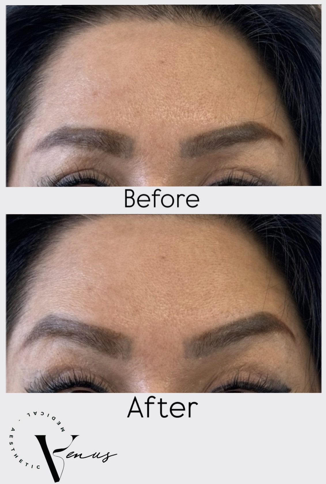 Before and after aesthetic treatment result 2 at Venus Clinic Laval