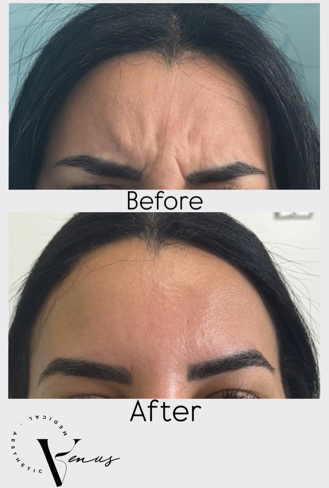 Before and after aesthetic treatment result 3 at Venus Clinic Laval
