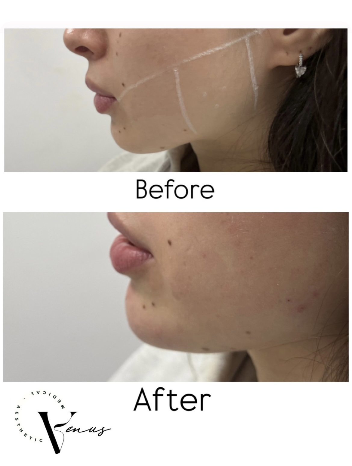 Before and after aesthetic treatment result 4 at Venus Clinic Laval