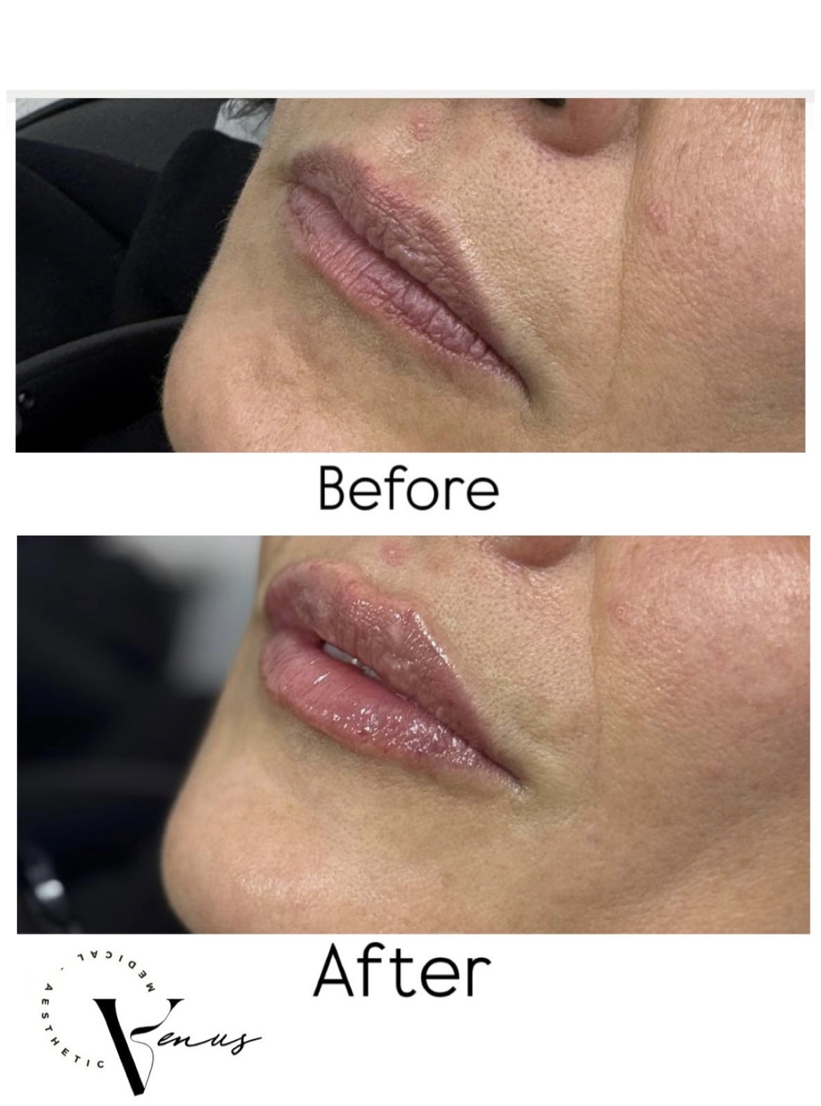 Before and after aesthetic treatment result 5 at Venus Clinic Laval