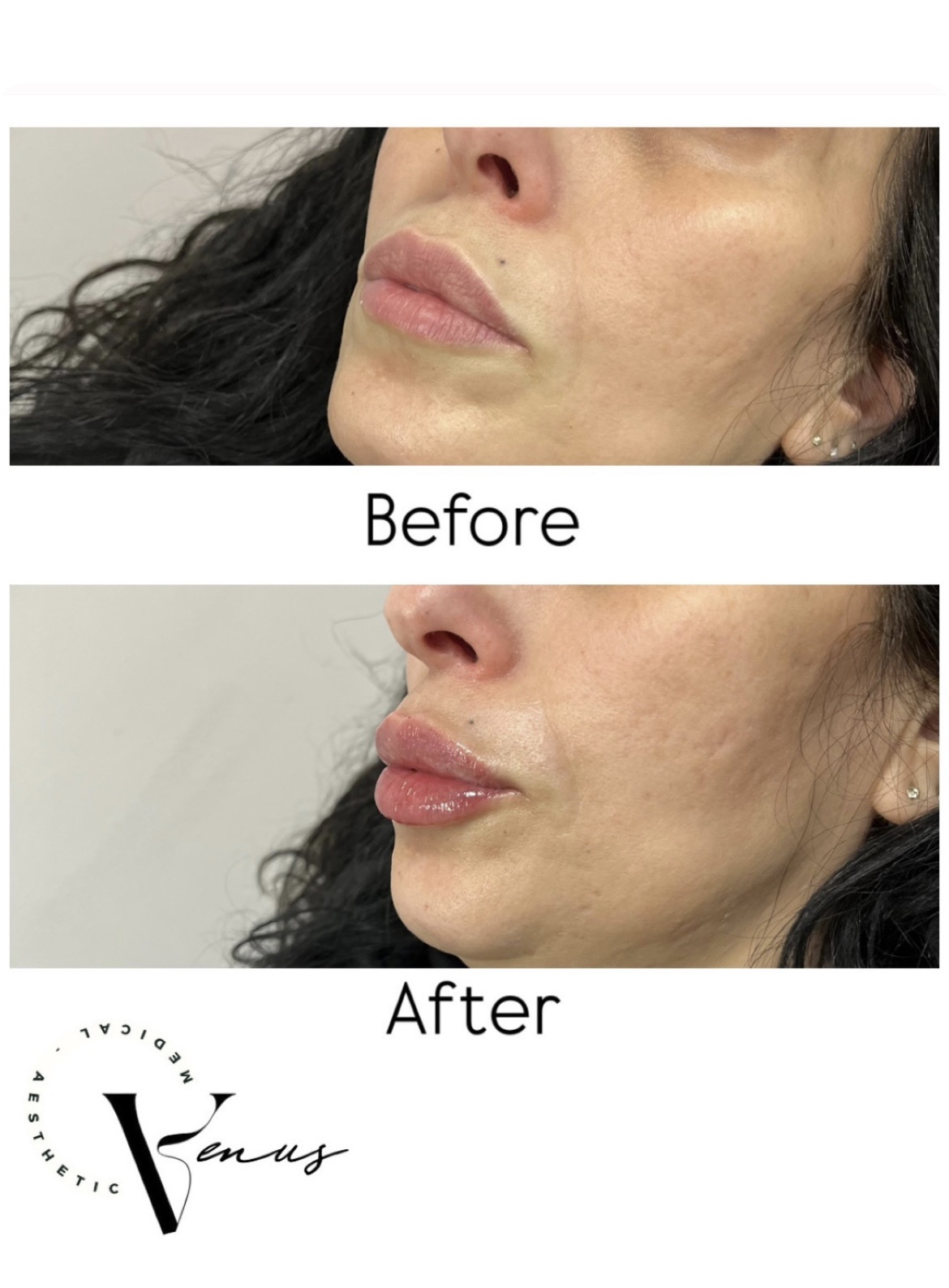 Before and after aesthetic treatment result 6 at Venus Clinic Laval