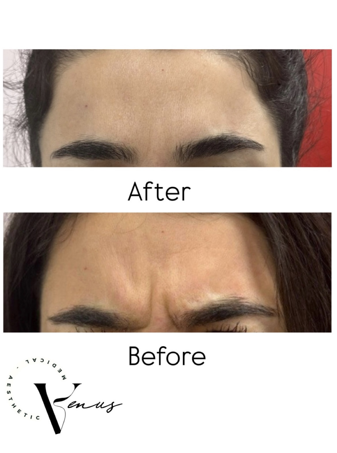 Before and after aesthetic treatment result 7 at Venus Clinic Laval